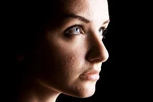 acne in Coraopolis, PA and Pittsburgh, PA