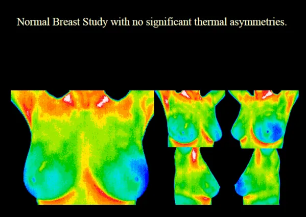 Health Concepts I - Chiropractor in Fayetteville, GA US :: Thermography