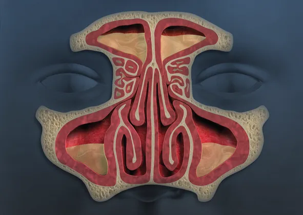 Diseased Sinuses