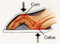 Corns_and_Calluses_3.jpg