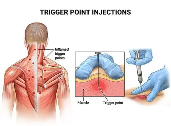 Trigger Point Injections