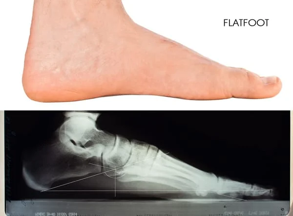 Adult acquired flatfoot deformity – fallen arches and flat feet treatments  – Caring Medical Florida