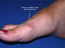 Best shoes for bone spurs on big toe online