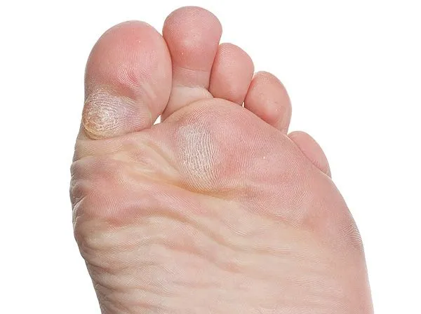 calluses_01.jpg