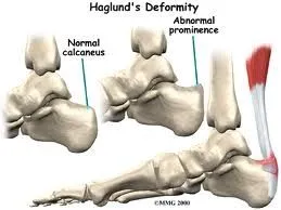 Haglunds_Deformity2.jpg