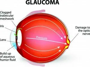 Glaucoma