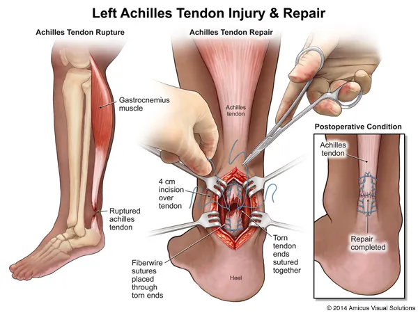 Achilles Tendinopathy and Achilles tendon partial and full thickness  rupture – Caring Medical Florida