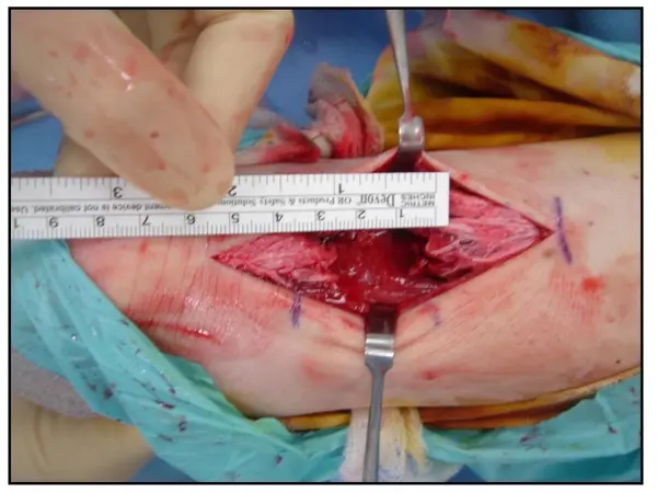 Achilles tendon rupture