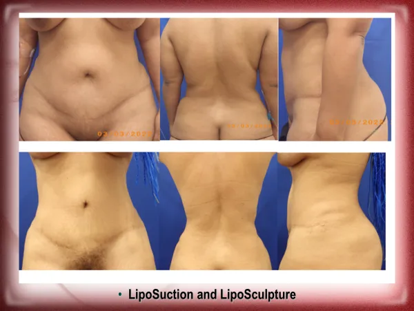 Liposuction in Huntington Beach, South Gate, Lake Forest, & Fontana, CA