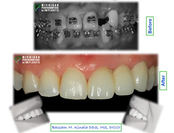 Dental Implants Birmingham MI