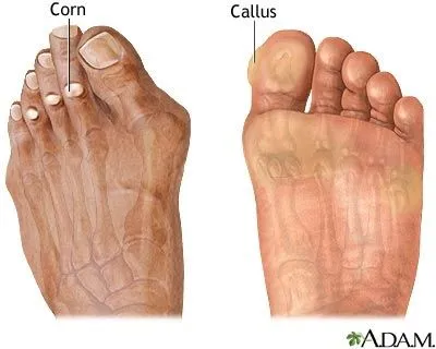 Corns_and_Calluses_1.jpg