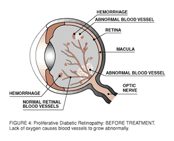 Diabetic Retinopathy