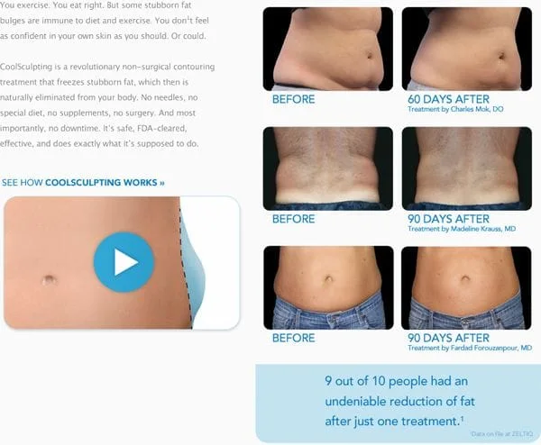 What Areas Can You Have Treated with Coolsculpting®