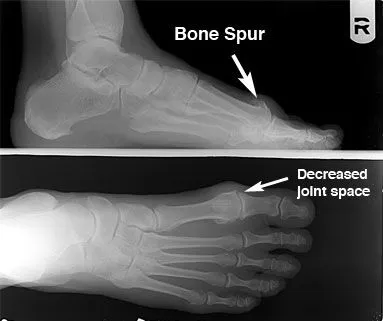 hallux_rigidus3.jpg