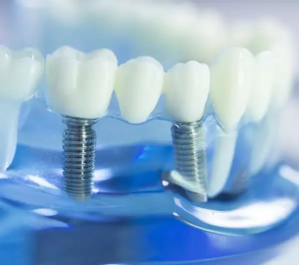 Dental implants in Laguna Niguel, CA