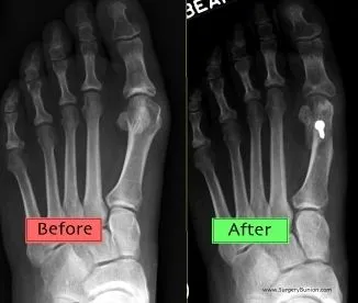 Bunions Boise Idaho.jpg