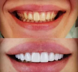 Fort Myers Veneers