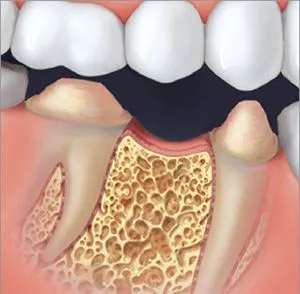 Dental Bridge Diagram