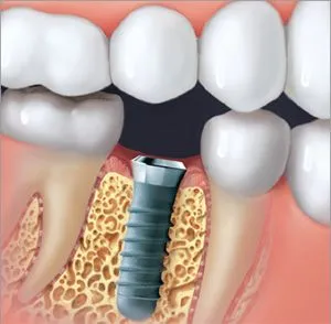 Dental Implant Screw