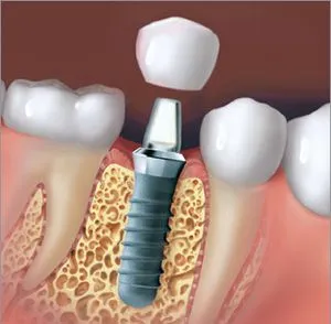 Dental Implant and Crown