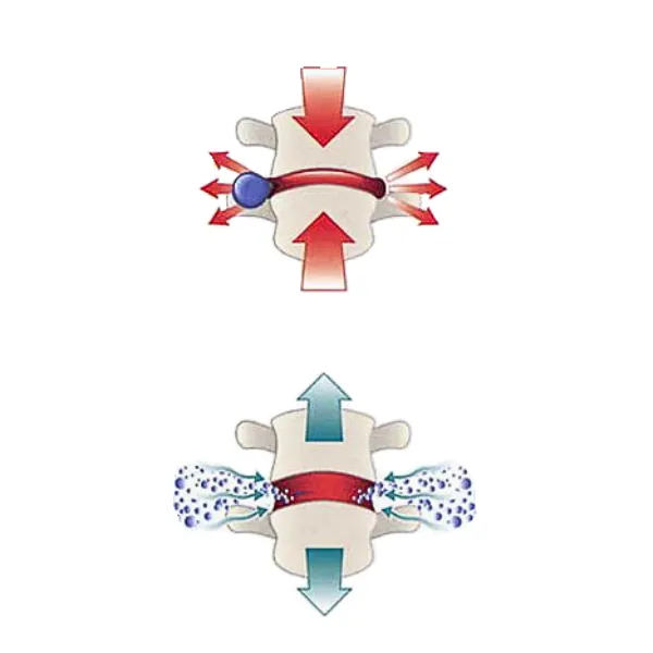 bulging disc, herniated disc, spinal decompression