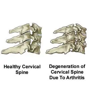 cervical_spondylosis.jpg
