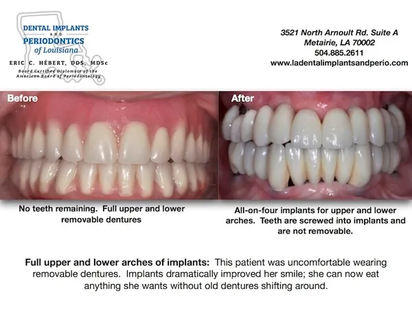 Full Arch Implants