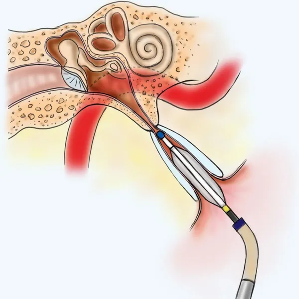 hearing loss treatment 2