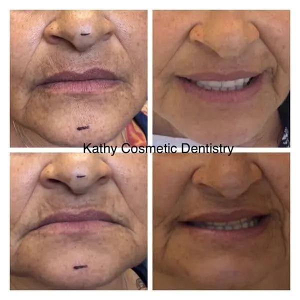 Before/After Dental Implants & Dentures Woodland Hills CA