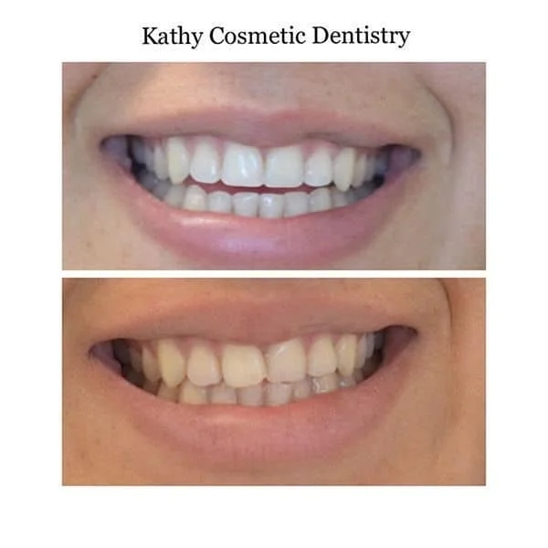 Before/After Invisalign Woodland Hills CA