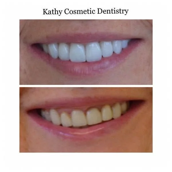 Before and After Veneers Woodland Hills