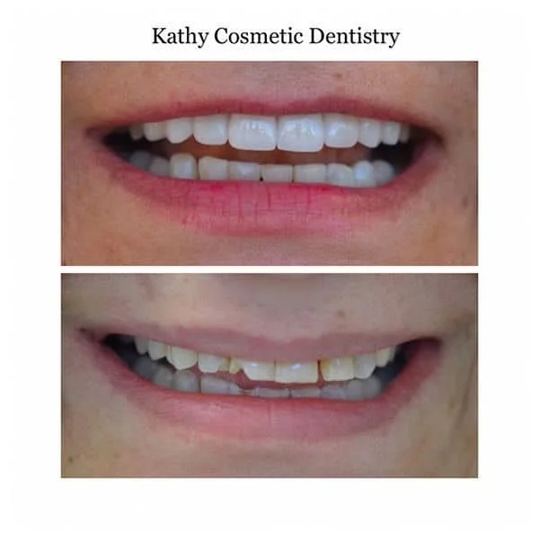 Before and After Veneers Woodland Hills