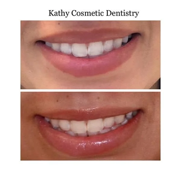 Before/After Teeth Whitening Woodland Hills CA