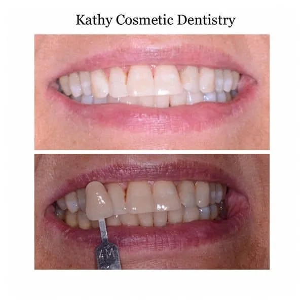 Before/After Teeth Whitening Woodland Hills CA