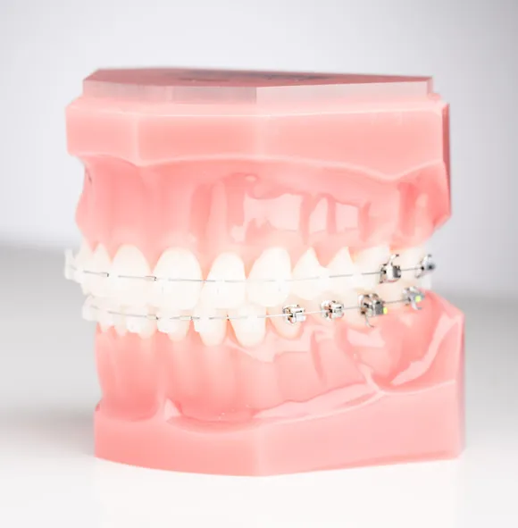 plastic model of teeth, back teeth have metal braces, front section of teeth have self-ligating ceramic braces Fairfax, VA orthodontics