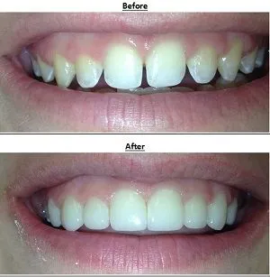 Cape May County, NJ Veneers