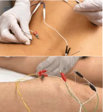 Shockwave therapy graph