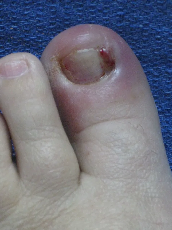 Ingrown Toenails