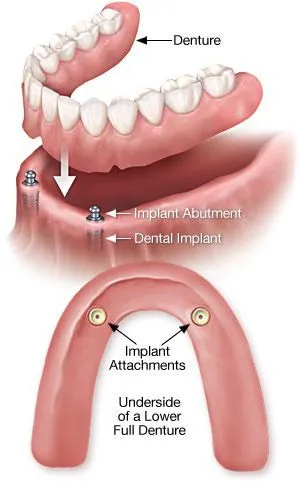 Locator attachments