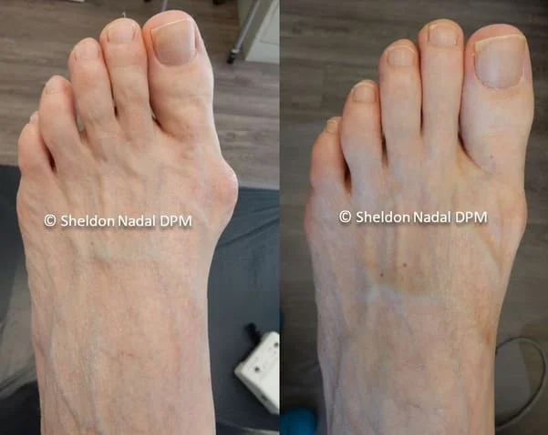54-year old woman pre-op 1-year post-op left foot.