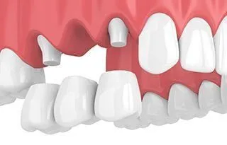 3D illustration of traditional dental bridge being placed in upper arch of mouth, dental bridges Acton, MA dentist