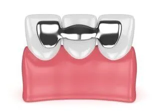 illustration of Maryland type dental bridge on teeth, dental bridges Acton dentist