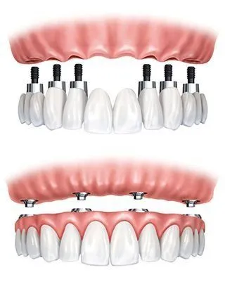 illustration of implant-supported dentures Old Bridge, NJ dentist
