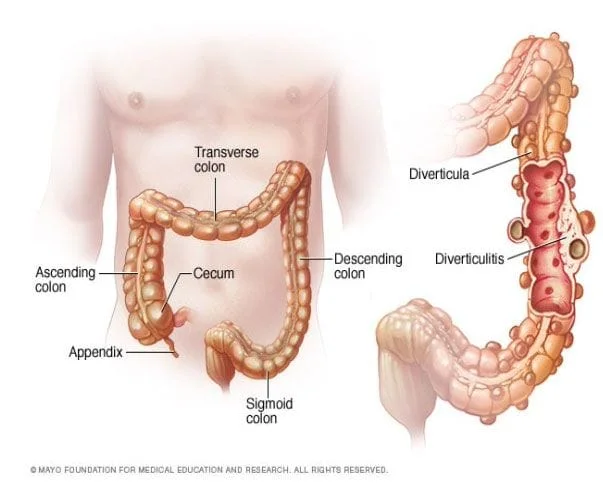 diverticulosis