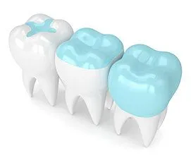 illustration of teeth with inlays, onlays, and dental crowns Melrose, MA dentist