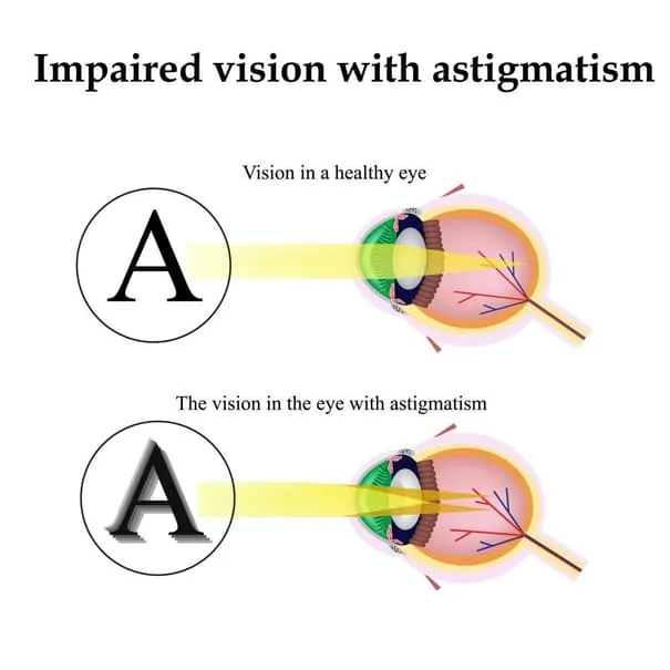 Mt. Pleasant Optometrist Explains Astigmatism