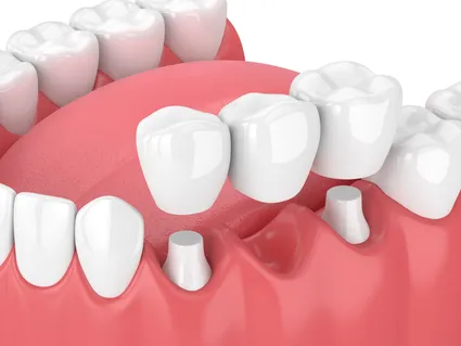 3D illustration of mouth and teeth, dental bridge being placed over abutment teeth, dental crowns and bridges Nottingham, MD dentist