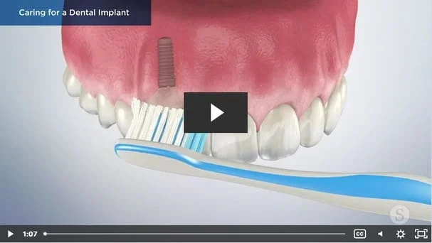 Caring for a Dental Implant