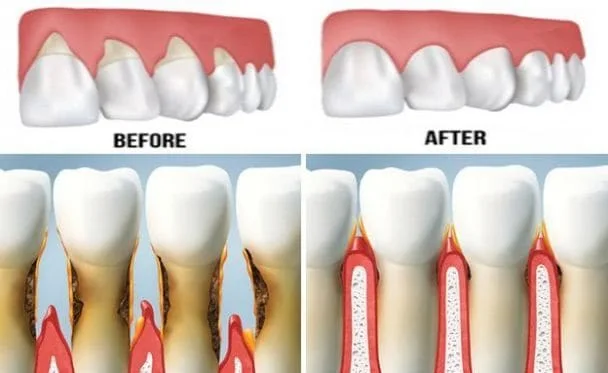 gum graft