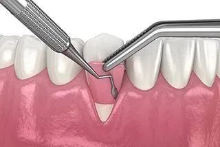illustration of dental tools placing gum graft around tooth, periodontics Muncie, IN periodontist